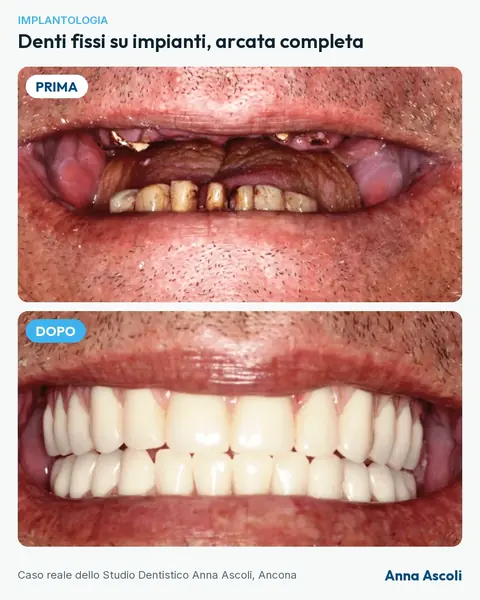 Prima e dopo: Denti fissi su impianti, arcata completa