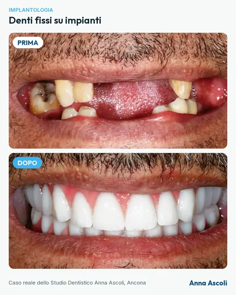 Prima e dopo: Denti fissi su impianti