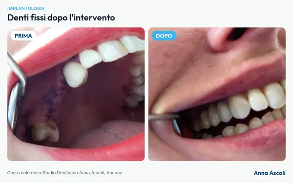 Prima e dopo: Denti fissi dopo l'intervento