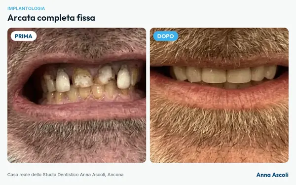 Prima e dopo: Arcata completa fissa