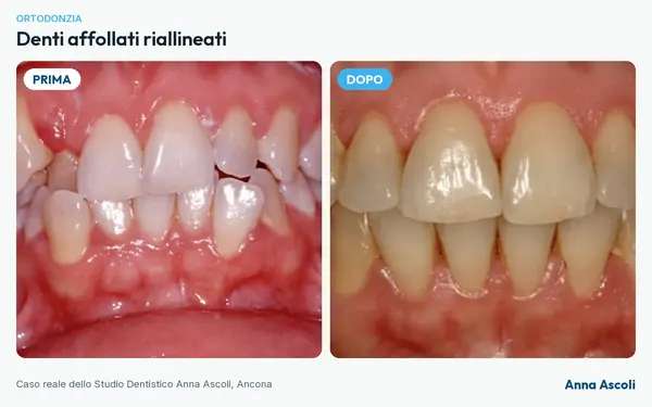 Prima e dopo: Denti affollati riallineati