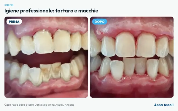 Prima e dopo: Igiene professionale: tartaro e macchie
