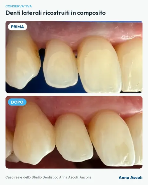 Prima e dopo: Denti laterali ricostruiti in composito