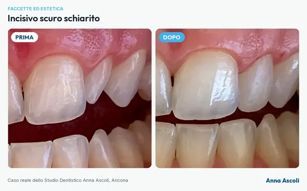 Prima e dopo: Incisivo scuro schiarito