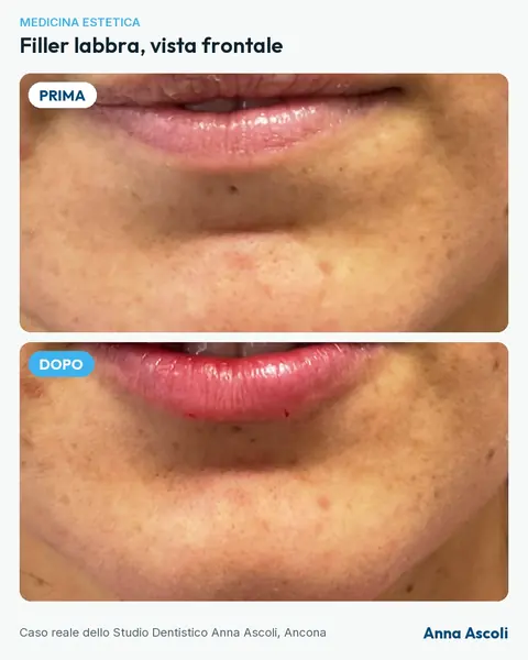 Prima e dopo: Filler labbra, vista frontale