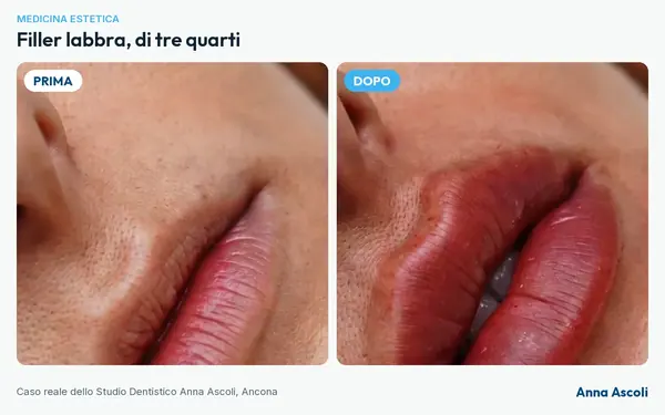 Prima e dopo: Filler labbra, di tre quarti