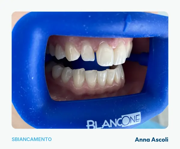 Sbiancamento in studio, arcate a riposo