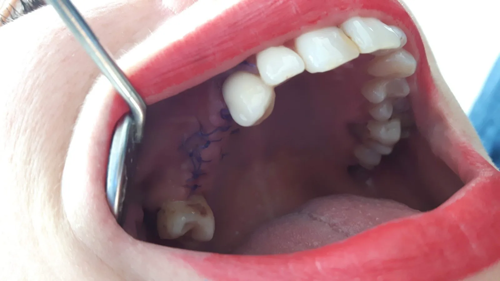 Vuoi superare la paura di inserire gli impianti? Leggi il caso di Caterina (prima)