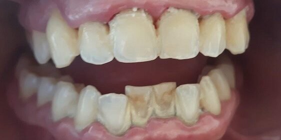 PRIMA Tartaro nei denti prima di una igiene dentale della dottoressa Anna Ascoli