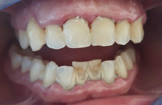 PRIMA Tartaro nei denti prima di una igiene dentale della dottoressa Anna Ascoli