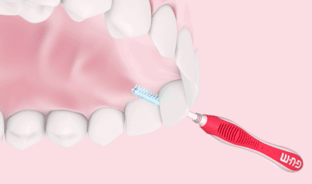 Come curare il tartaro nei denti? Rimozione tartaro Ancona
