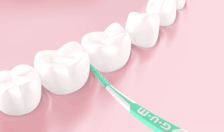 Come curare il tartaro nei denti? Rimozione tartaro Ancona