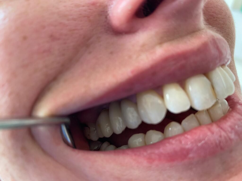 Vuoi superare la paura di inserire gli impianti? Leggi il caso di Caterina (dopo)