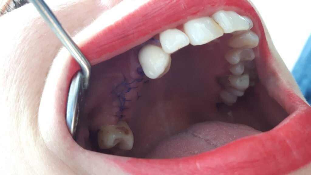 Vuoi superare la paura di inserire gli impianti? Leggi il caso di Caterina (prima)
