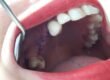Vuoi superare la paura di inserire gli impianti? Leggi il caso di Caterina (prima)