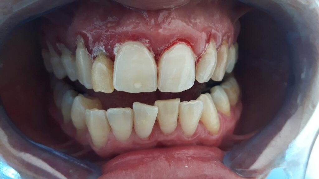 Come ho salvato i denti di Luisa dalla parodontite (prima)