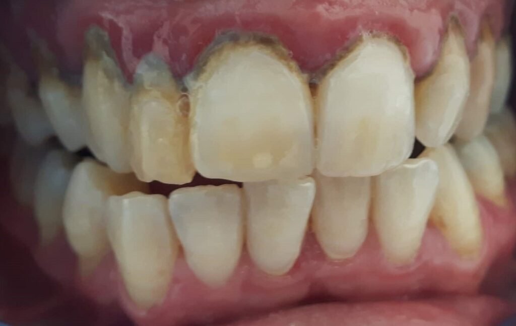 Come ho salvato i denti di Luisa dalla parodontite