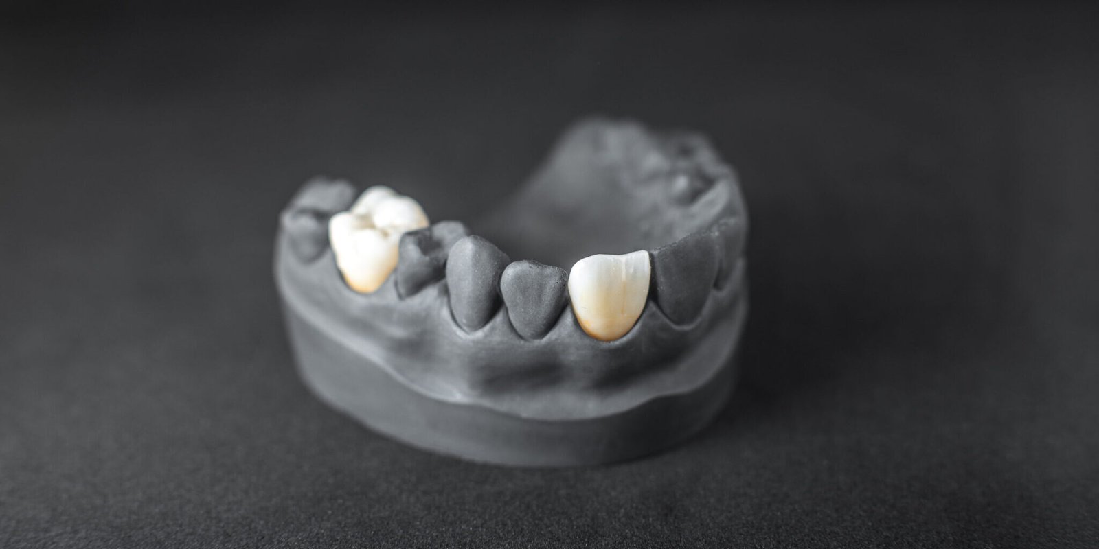 capsula dentale in una impronta capsula dentale ancona