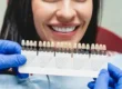 Faccette dentali: cosa sono e quando metterle