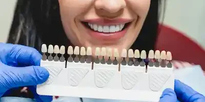Faccette dentali: cosa sono e quando metterle