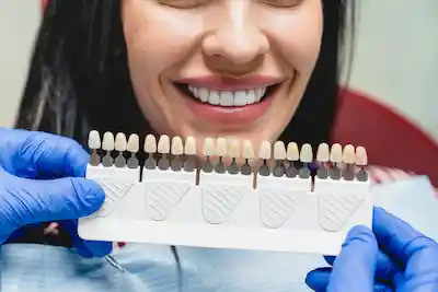 Faccette dentali: cosa sono e quando metterle