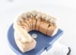Protesi dentale dentista Ancona