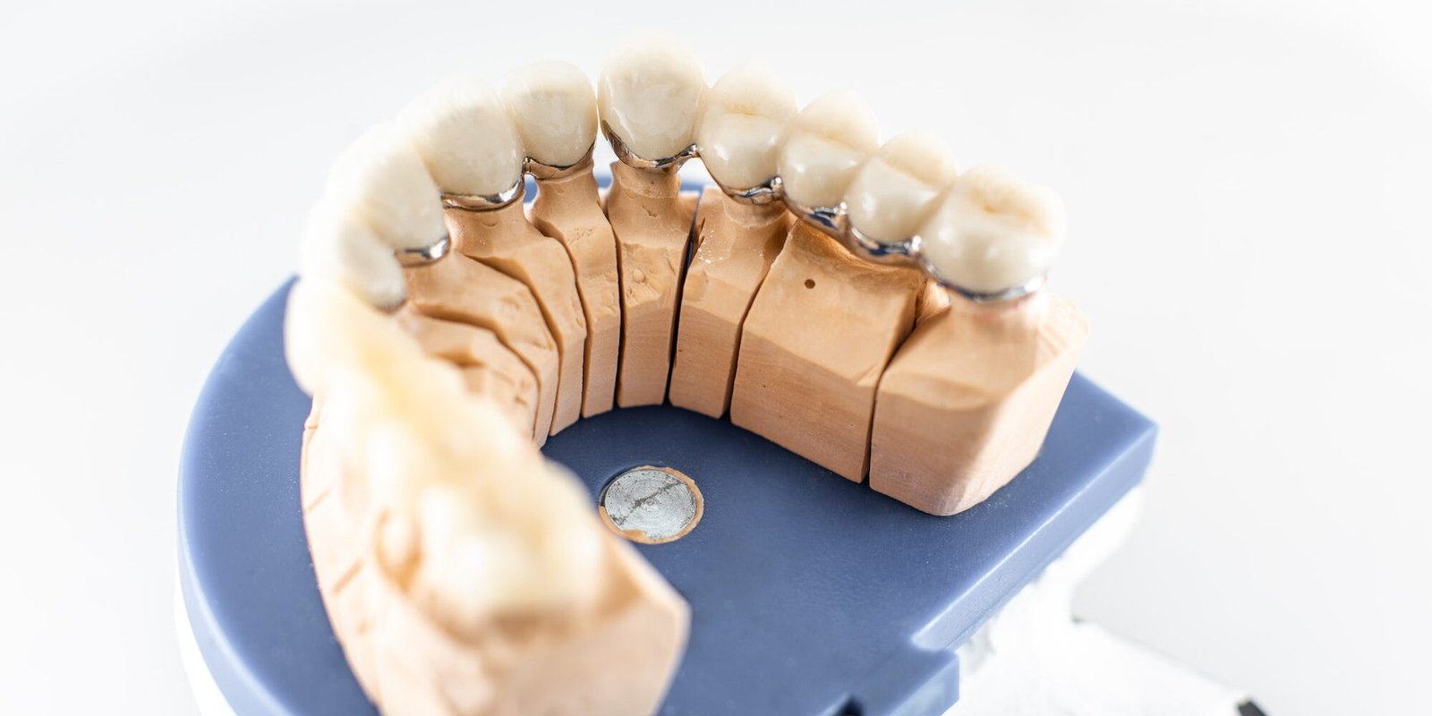 Protesi dentale dentista Ancona