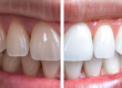 Faccette dentali ancona