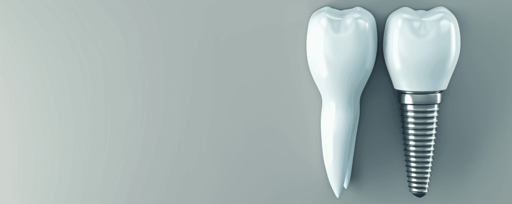 Impianti Dentali ad Ancona: Tutto Quello che Devi Sapere