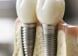 impianti dentali ancona