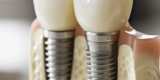 impianti dentali ancona impianti dentali ancona