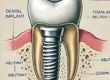 disegno impianto dentale